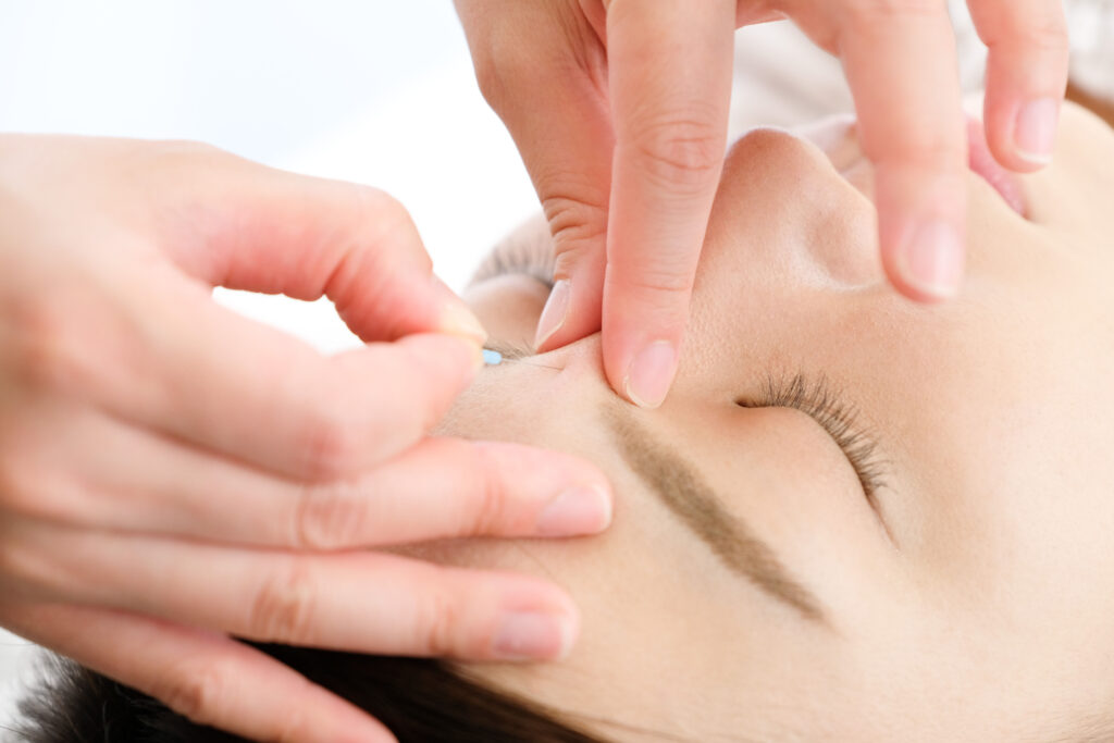 Séance d'acupuncture sur le visage